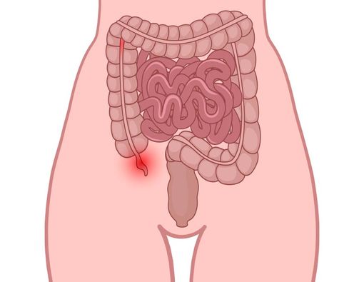 Mengapa Usus Buntu Terjadi Lagi Meski Sudah Dioperasi?