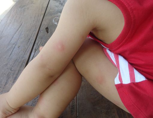 Mengapa Anak Sering Bisulan?