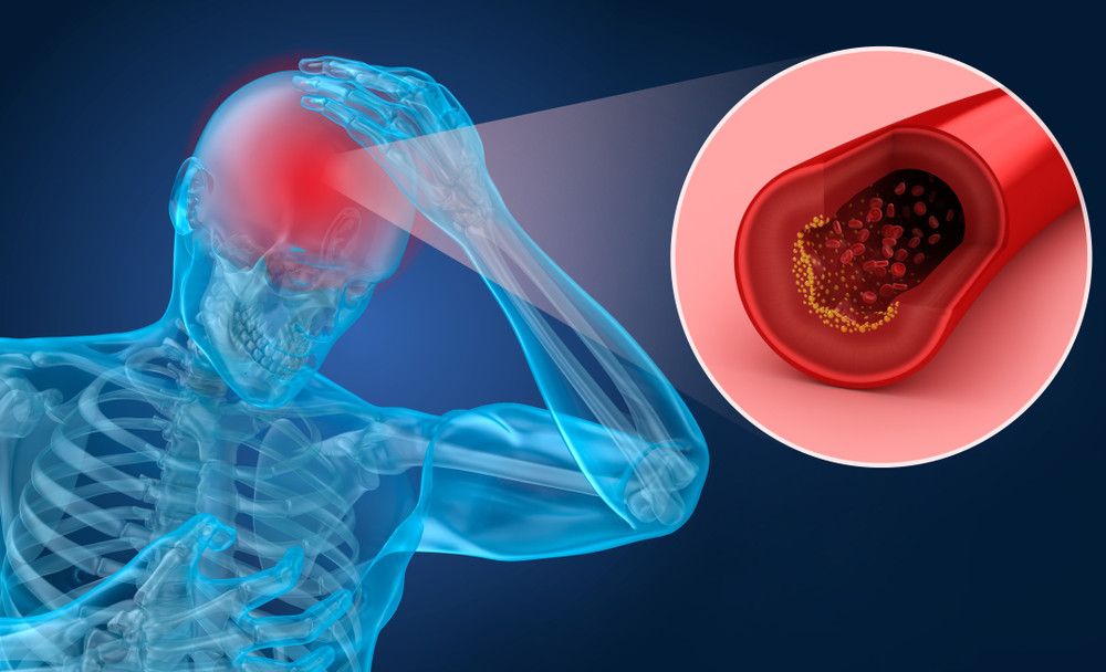6 Komplikasi Stroke yang Perlu Anda Tahu