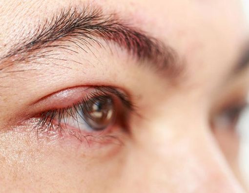 Benarkah Bintitan Terjadi Akibat Tidak Cuci Tangan?