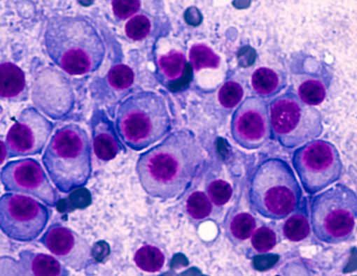 Yuk, Kenali Penyakit Multiple Myeloma Lebih Jauh!