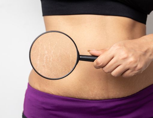 Cegah dan Atasi Stretch Mark dengan Cara Alami Ini