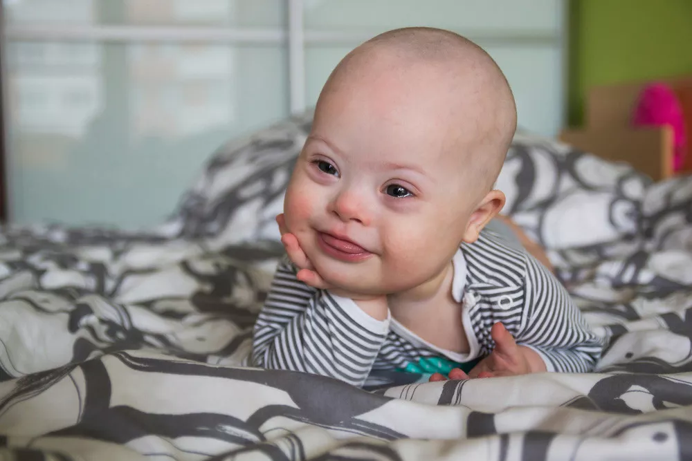 Kenali Ciri-Ciri Bayi Down Syndrome