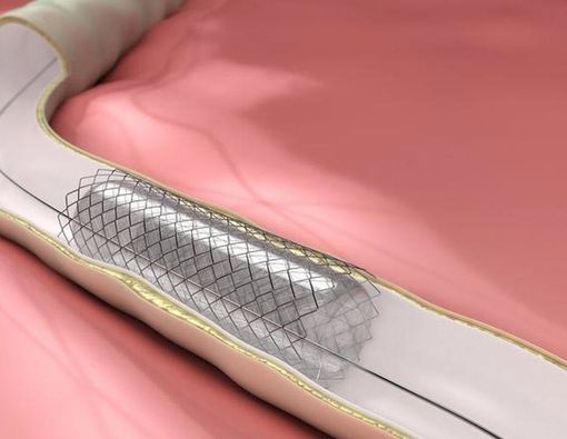 Sekilas Tentang Material Ring Jantung, Prosedur, dan Efeknya