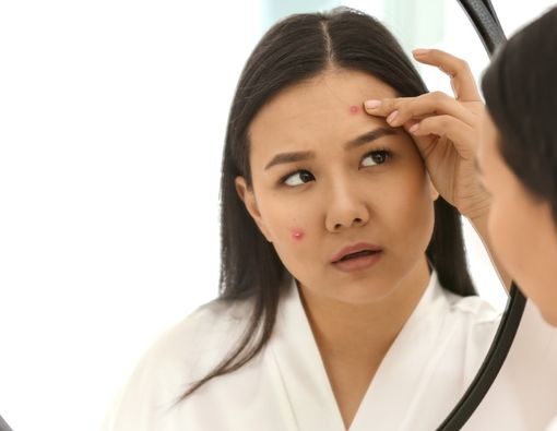 Apakah Jerawat Merupakan Tanda Awal PMS?