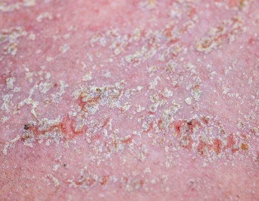 Jangan Keliru, Ini Perbedaan Dermatitis Seboroik dan Psoriasis