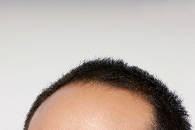 Cara Mengatasi Kebotakan Rambut