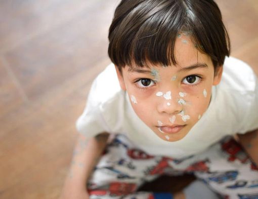 Inilah 5 Penyakit Khas Anak Sekolah