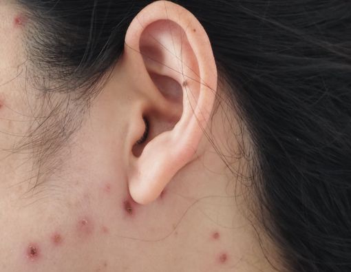 Belum Pernah Terkena Cacar Air Saat Dewasa, Haruskah Vaksin Ulang?