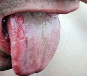 Bercak Putih di Mulut, Tanda HIV/AIDS?