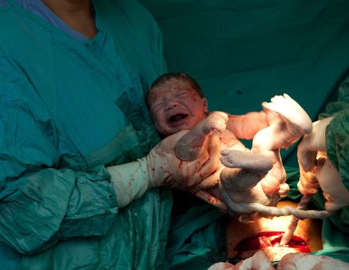 Berapa Batas Maksimal Melakukan Operasi Caesar yang Aman?