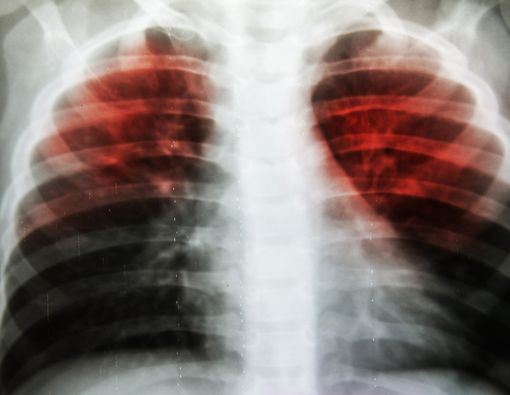 Waspadai Bahaya Penularan TB Paru!