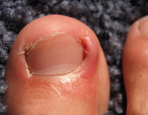 Tips Mengatasi Cantengan dengan Bahan Alami