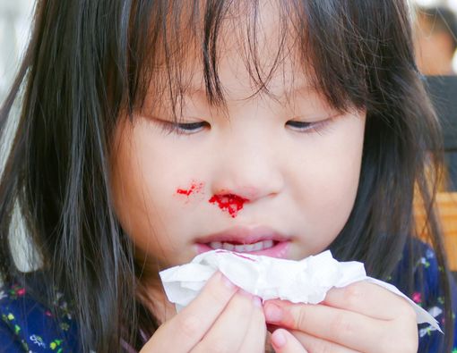 Penyebab dan Cara Mengatasi Mimisan pada Anak