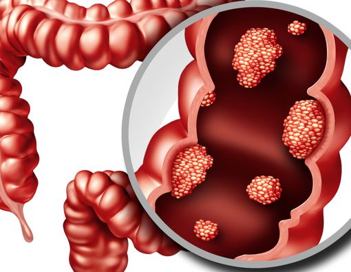 Hindari Kanker Usus dengan Konsumsi Makanan Ini