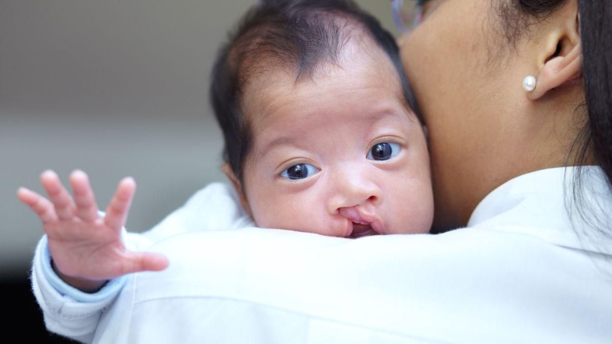 Operasi Bibir Sumbing pada Bayi, Ini Persiapan dan Prosedurnya