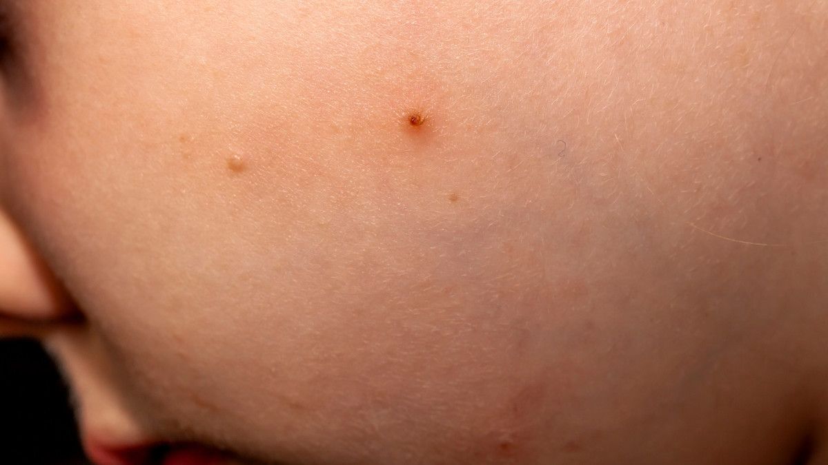 4 Infeksi Kulit yang Sering Terjadi pada Anak