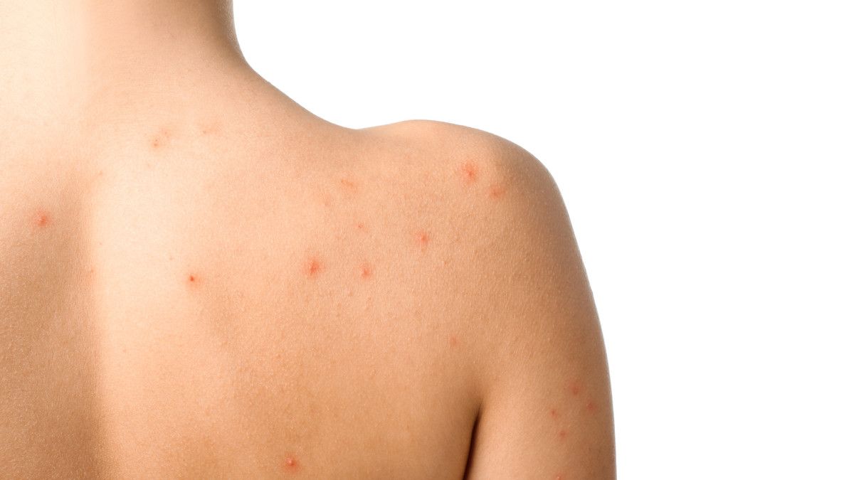 11 Hal Tak Terduga Penyebab Jerawat di Punggung