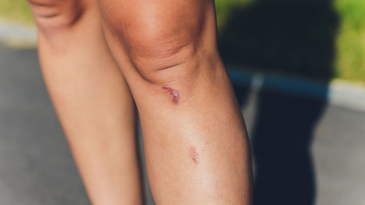 Keloid