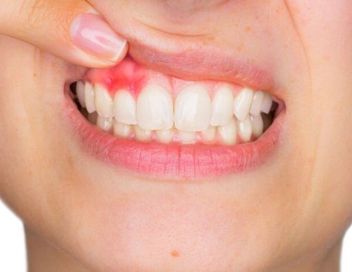 Ada Benjolan di Gusi, Kapan Perlu ke Dokter Gigi?