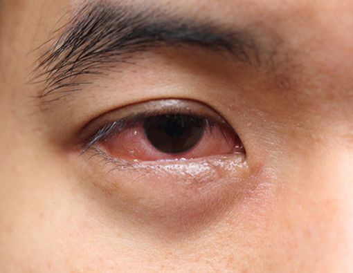 10 Penyebab Mata Merah yang Tidak Boleh Disepelekan