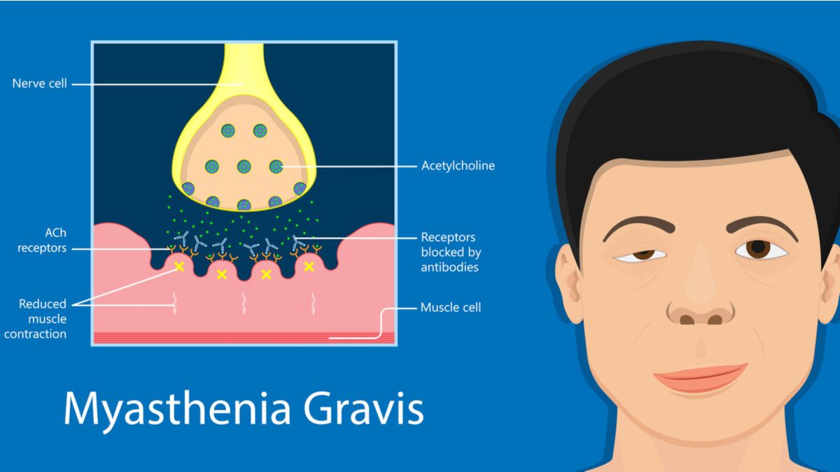 Hidup Normal dengan Myasthenia Gravis, Bagaimana Caranya? - KlikDokter