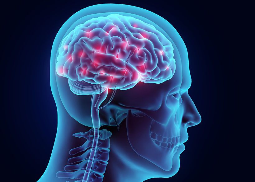 Fakta Medis Lengkap Seputar Stroke Iskemik