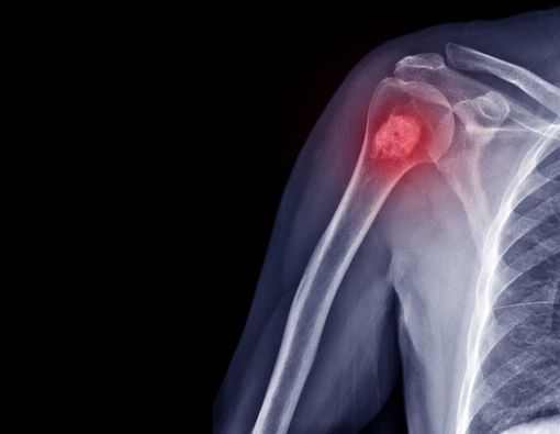 Mengenal Prosedur Limb Salvage untuk Mengatasi Kanker Tulang