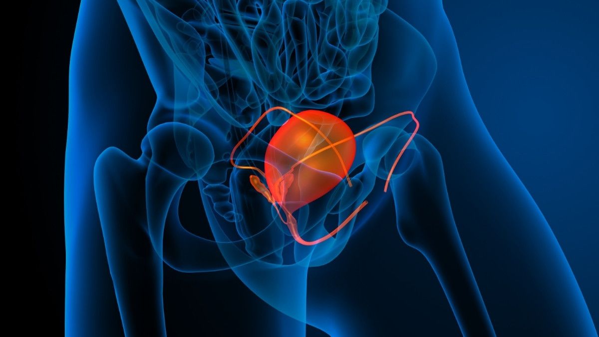 Mengenal Stadium Kanker Kandung Kemih dan Pengobatannya