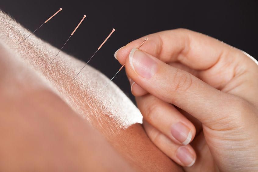 Terapi Akupunktur untuk Radang Sendi
