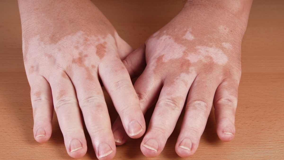 Waspadai 5 Gejala Vitiligo pada Kulit!