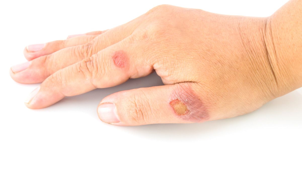 4 Cara Menghilangkan Bekas Koreng dengan Mudah