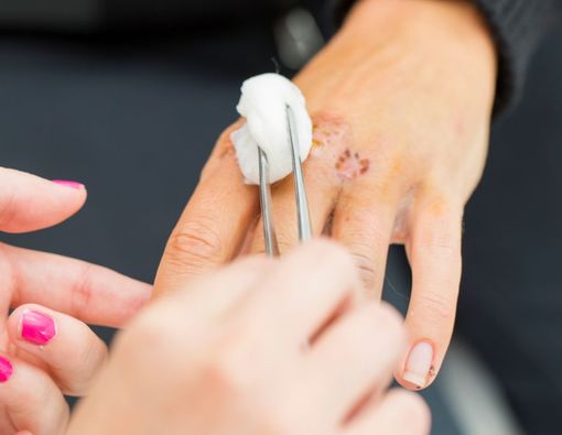 Jangan Keliru, Ini 4 Jenis-Jenis Luka dan Cara Tepat Merawatnya