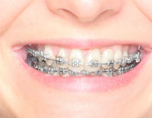 Mengenal Perawatan Orthodonti, Jenis dan Prosedurnya