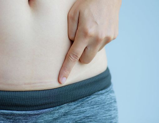 Mengapa Bekas Luka Operasi Caesar Harus Segera Dirawat?