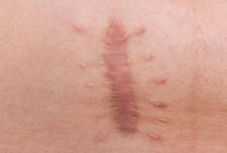 Keloid dan Pengobatannya