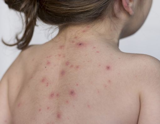 Cacar Air dan Cacar Api, Kenali Perbedaannya