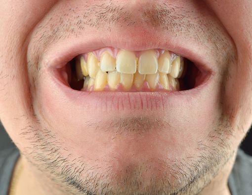 Penyebab Gigi Kuning yang Mungkin Belum Anda Ketahui