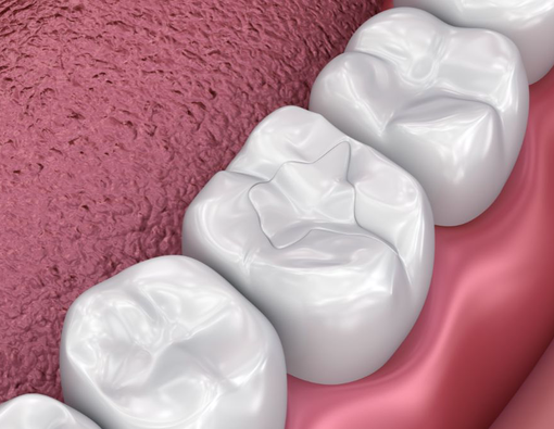 Cegah Karies Gigi Sejak Dini dengan Fissure Sealant