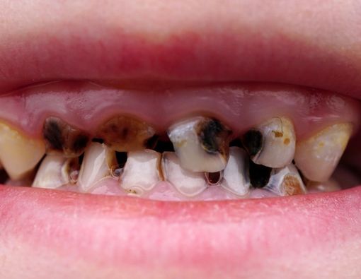 Cara Mencegah Gigi Busuk pada Anak