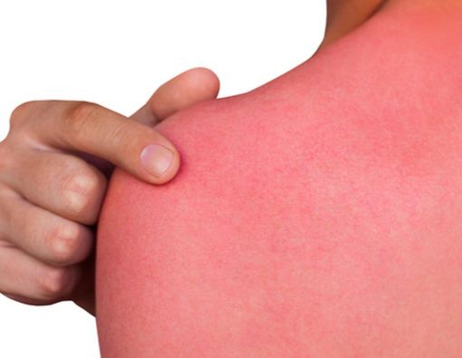 Cara Mudah Mengatasi Kulit Terbakar Sinar Matahari