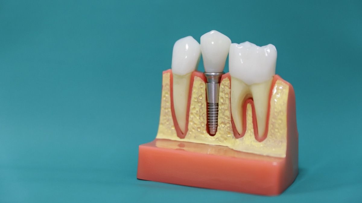 Bolehkah Penderita Osteoporosis Implan Gigi? Ini Kata Dokter