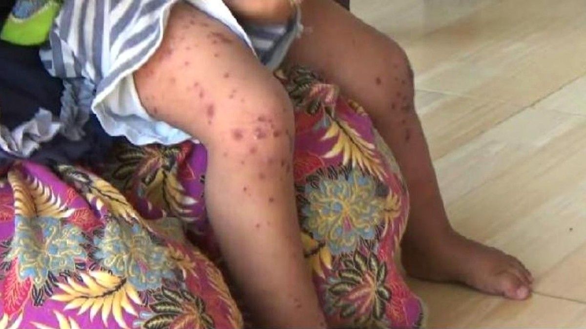 Kenali Gejala Flu Singapura untuk Lakukan Antisipasi (Foto: Abramena/Liputan6)