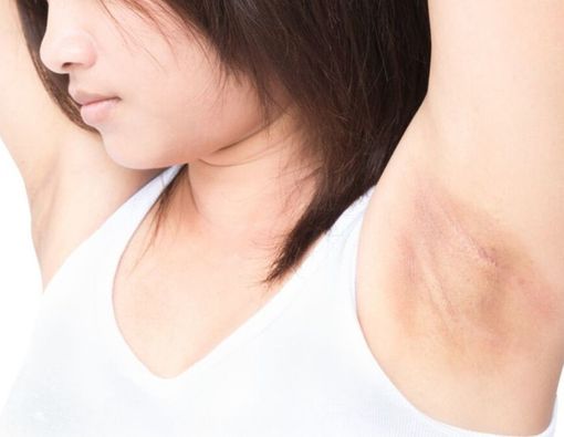Ketiak Hitam Akibat Deodoran, Ini Cara Memutihkannya