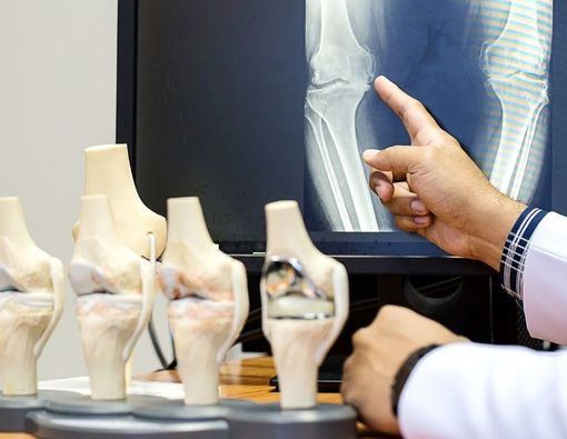8 Kebiasaan Penyebab Osteoporosis, Bikin Tulang Keropos!