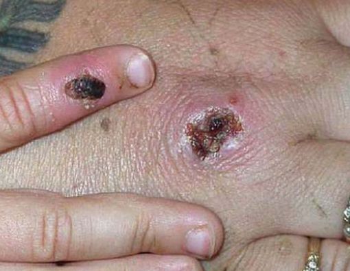 Kena Cacar Monyet, Berapa Lama Akan Sembuh?