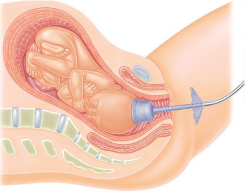 Lahir dengan Bantuan Vakum Membuat Anak Bodoh?