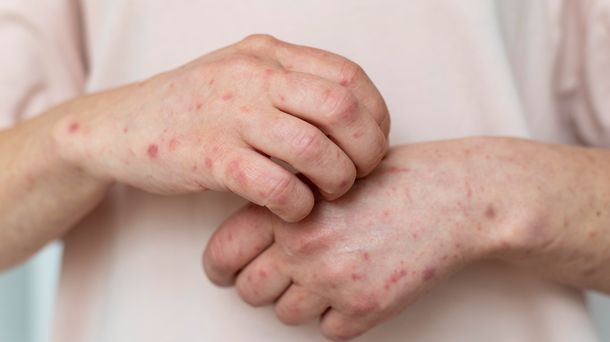 Bahaya Flu Singapura pada Anak Balita yang Sering Diabaikan Orang Tua