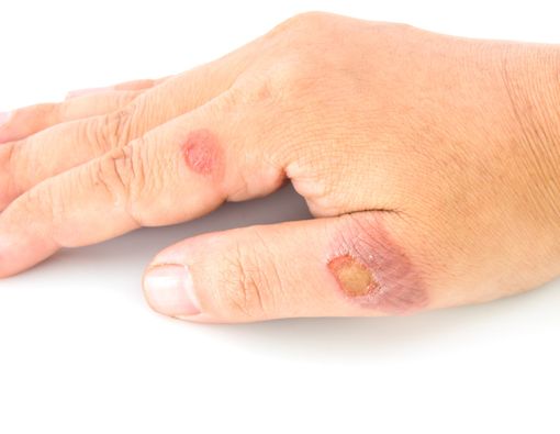 4 Cara Menghilangkan Bekas Koreng dengan Mudah