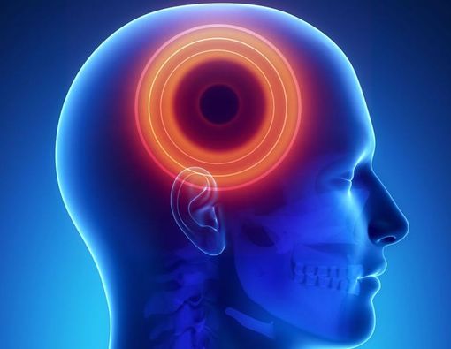 Kenali Jenis Sakit Kepala yang Kerap Menyerang Anda